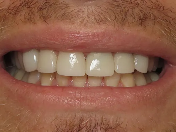 After image