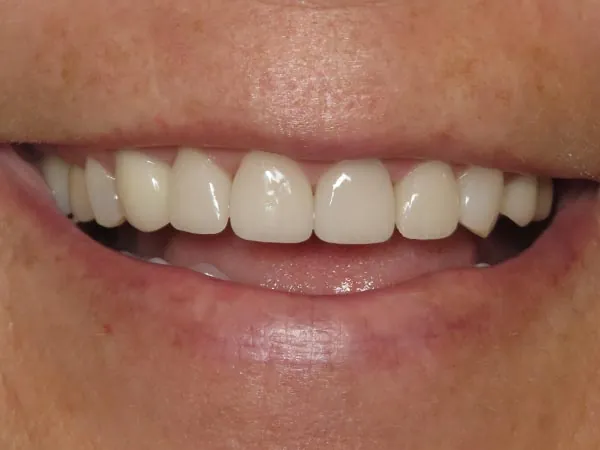 After image