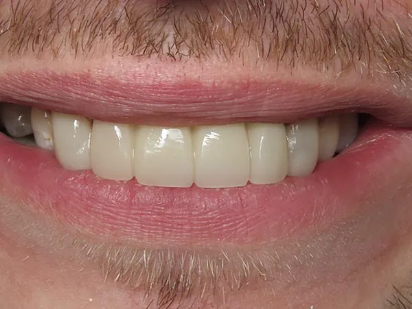 After image
