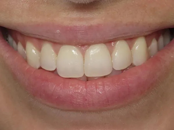 After image