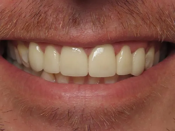 After image